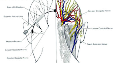 occipital nerve block dallas